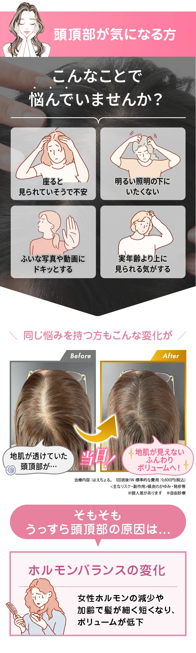 頭頂部の薄毛